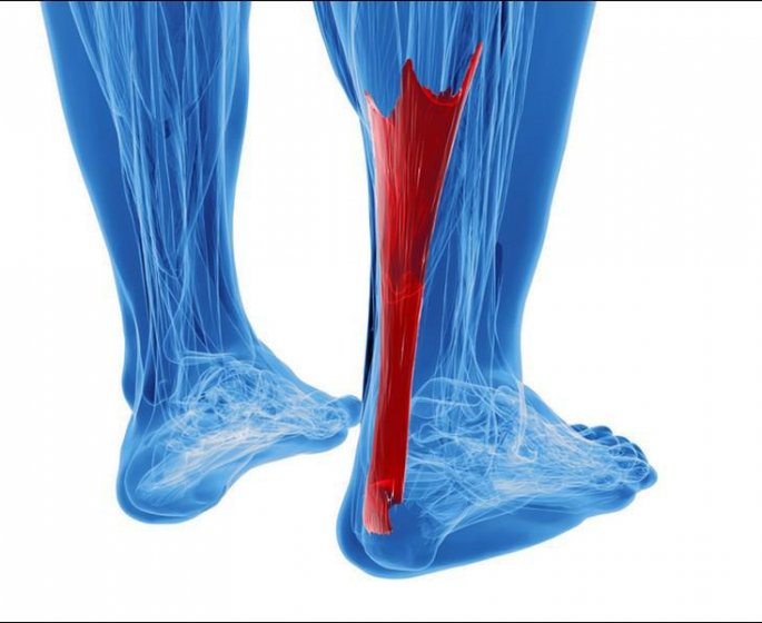 Rupture partielle du tendon d-Achille : les signes
