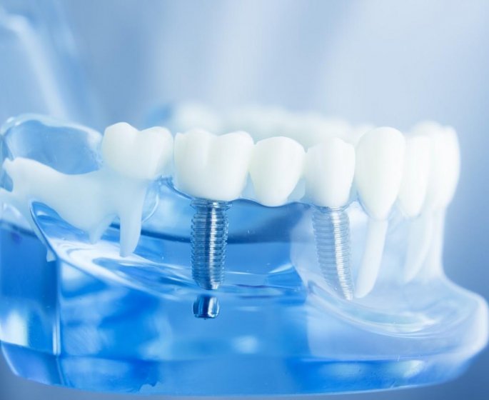 Protheses dentaires : 7 complications que vous risquez si vous en portez une