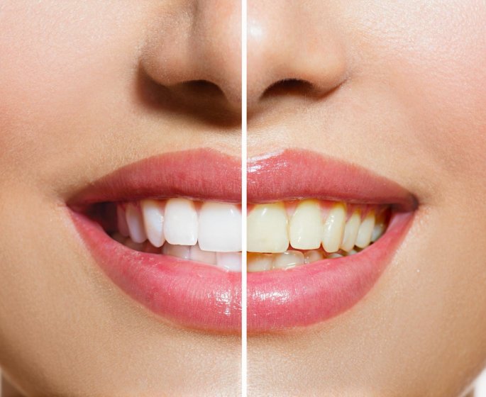 Blanchiment dentaire : 7 choses a savoir avant !