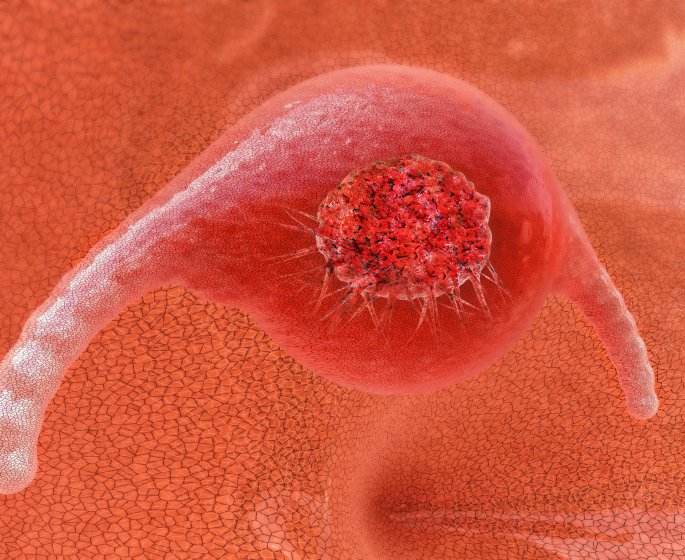 Cancer des ovaires et kyste ovarien : la difference