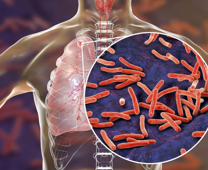 Tuberculose : les signes a reperer