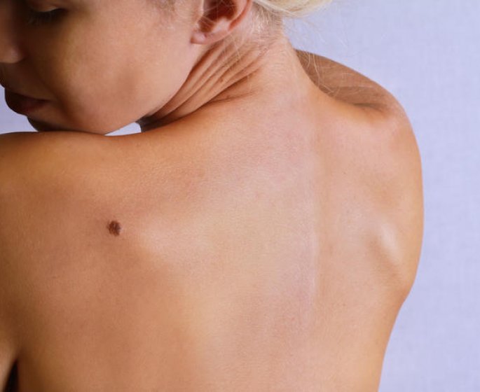 Cancer de la peau : definition du carcinome epidermoide