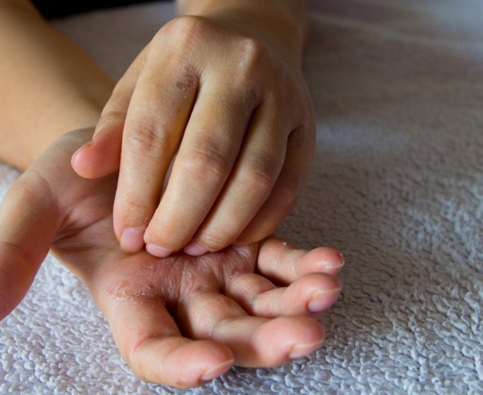 Eczema ou mains seches : comment faire la difference ? 