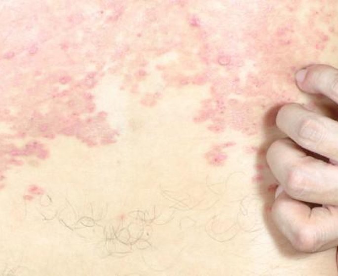 Psoriasis, eczema, dermite seborrheique et dermatite atopique : quelles differences ?