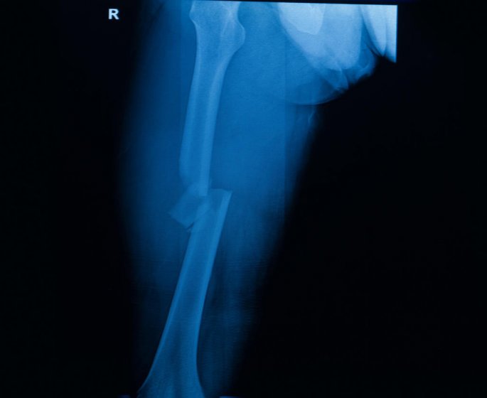 Fracture du femur : le traitement par clou gamma