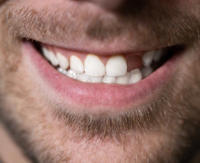 Ces maladies qui peuvent vous faire perdre vos dents
