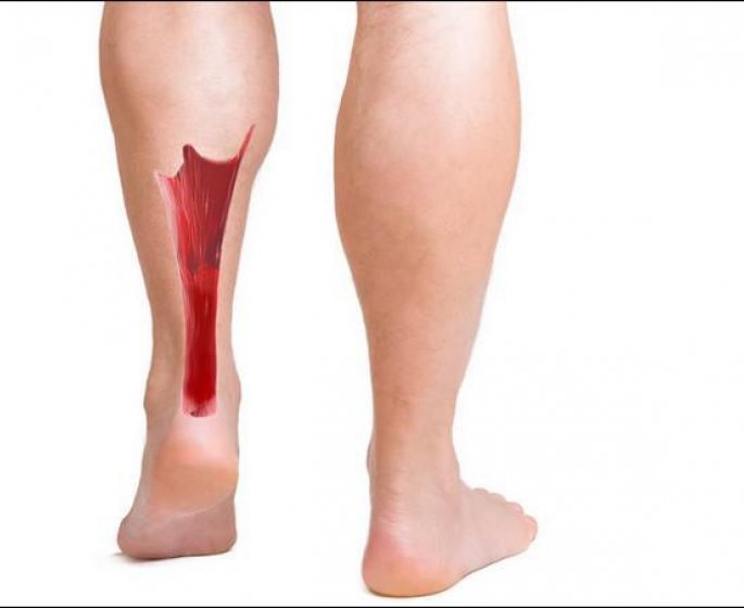 Rupture du tendon d-Achille : les causes
