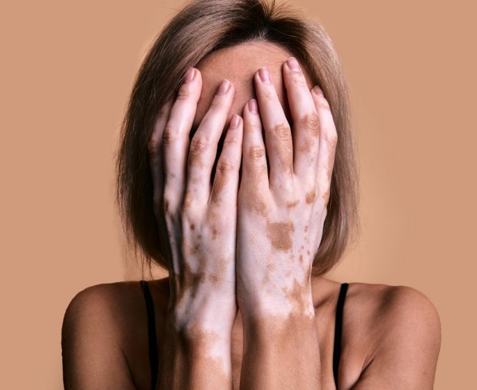 Vitiligo : comment reconnaitre les premiers signes ?