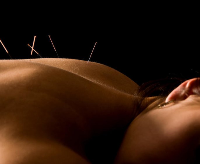 Sciatique : l-acupuncture efficace ?