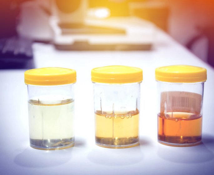 Deshydratation : la couleur de votre urine peut la reveler