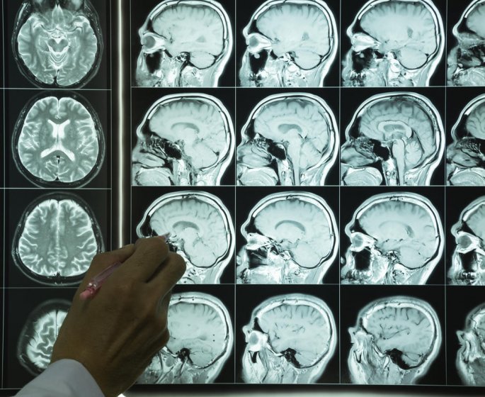 Tumeur au cerveau : est-ce toujours un cancer ?
