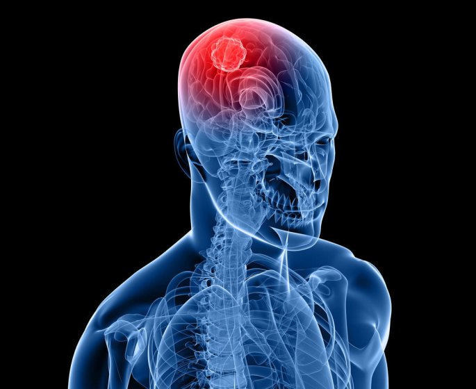 Cancer du cerveau : les principaux facteurs de risque