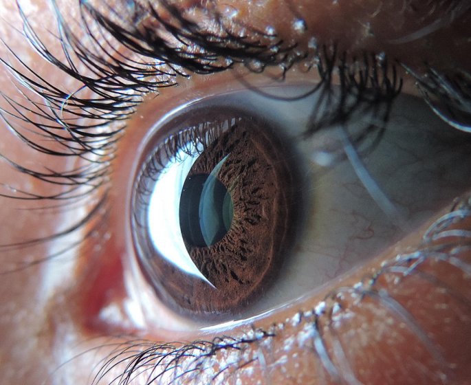 Decollement de la retine : la definition