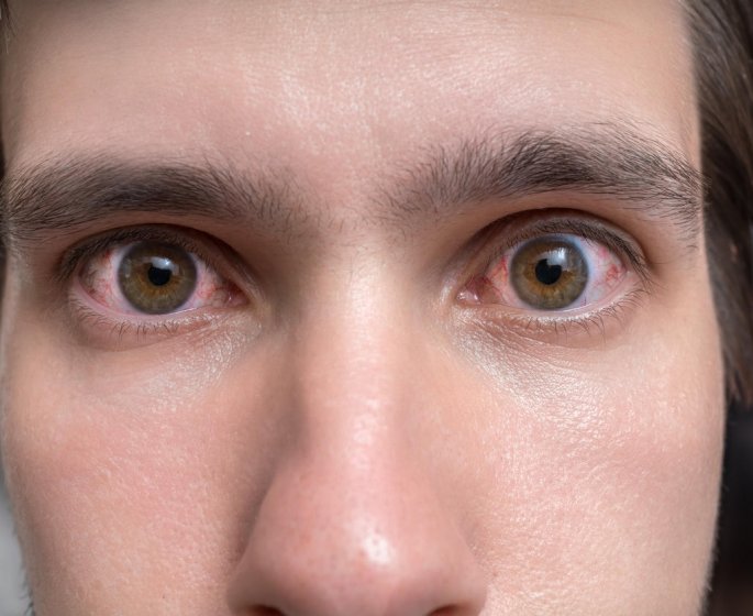 Blanc des yeux rouge : la conjonctivite allergique