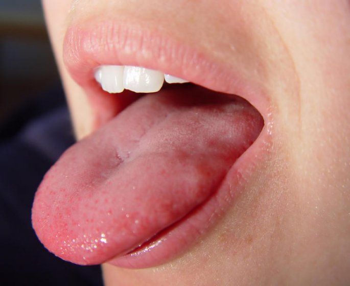 Ronflement : Votre langue est-elle trop grosse ?