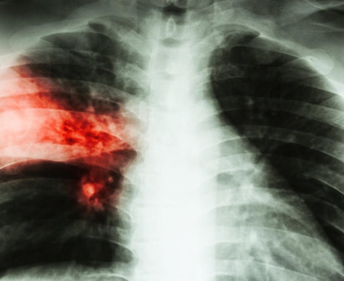 Cancer bronchique : quels sont les signes ?