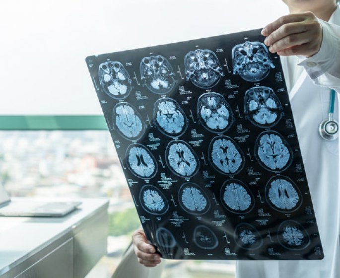 Canada : 42 personnes touchees par une maladie du cerveau inconnue