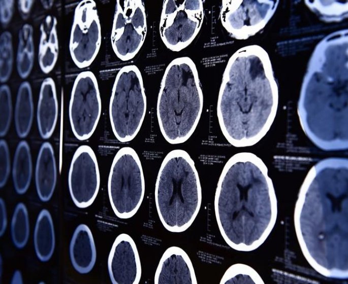 L’accumulation de lipides dans le cerveau pourrait etre un signe precoce de Parkinson