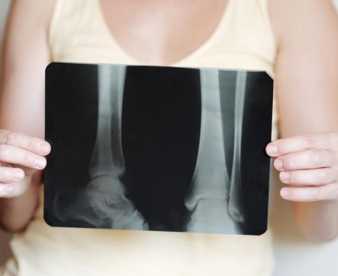 Osteoporose : c-est quoi la demineralisation osseuse ?