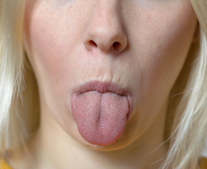 3 raisons qui vous donnent des aphtes sur la langue