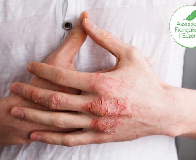 Eczema chronique des mains : de fortes repercussions sur la vie des patients