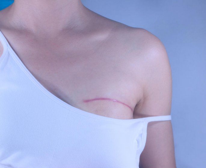 Cancer du sein : la convalescence apres une ablation mammaire