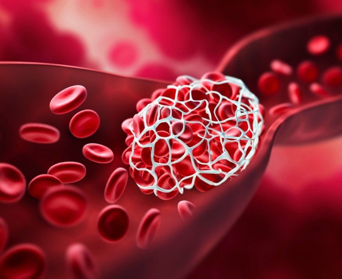 Caillots sanguins : un risque accru jusqu’a 6 mois apres la covid-19