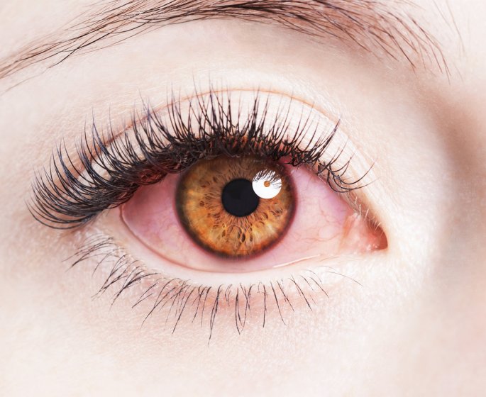 11 maladies qui donnent les yeux rouges