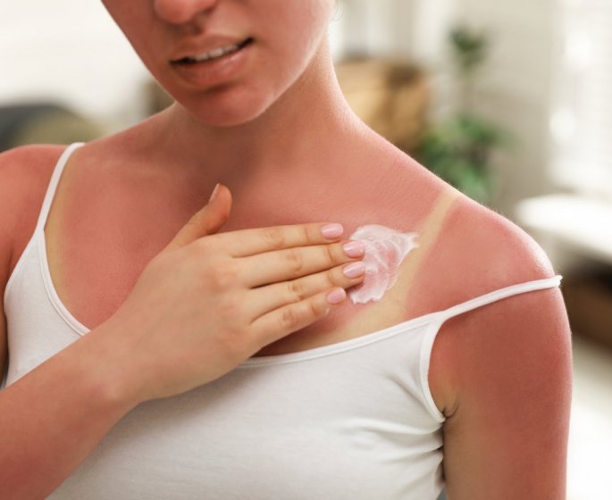 Coup de soleil : 8 conseils d’une dermatologue pour les apaiser et derougir