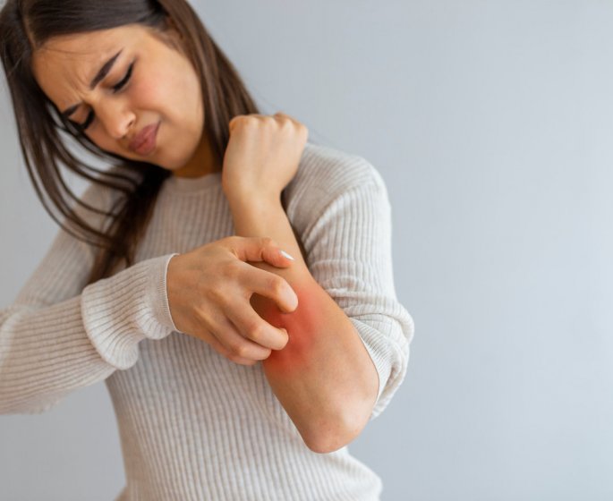 Eczema : 5 regimes a essayer pour reduire les symptomes 