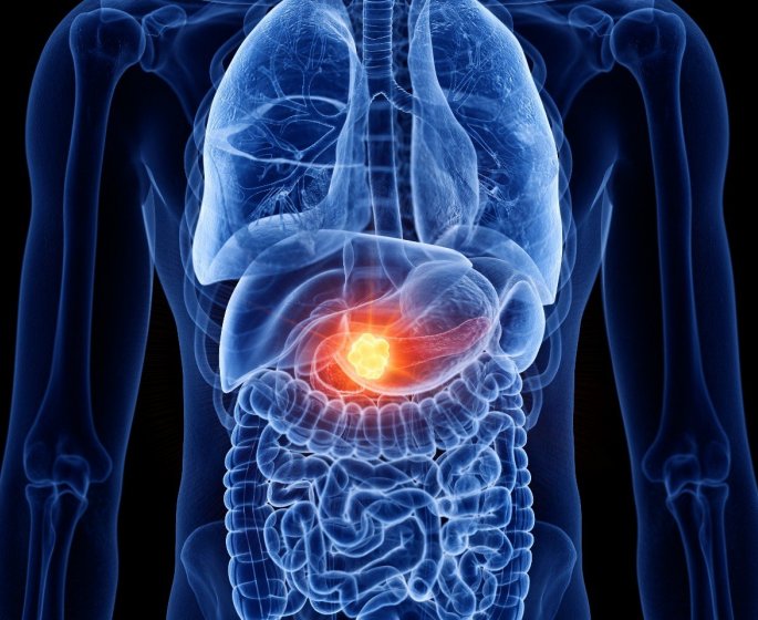 Cancer du pancreas : ces 5 sensations dans les jambes peuvent etre un signe
