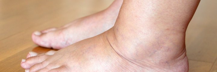 3 causes qui expliquent les pieds gonflés