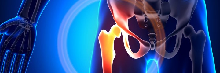 Arthrose de la hanche : lutter contre les douleurs nocturnes