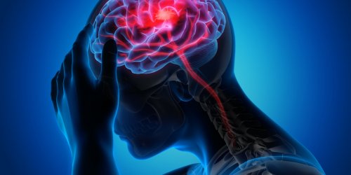 Accident vasculaire cerebral (AVC) : symptomes, definition, signes, causes, traitements