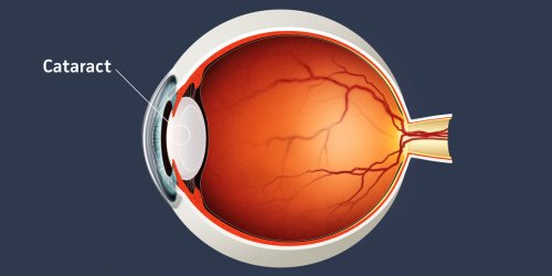 Cataracte : definition, symptomes, operation et traitements 