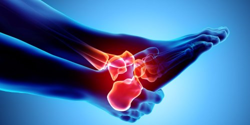 Aponevrosite plantaire (fasciite plantaire) : quels traitements pour soulager la douleur au pied ?