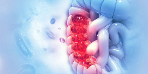 Cancer du colon : quels sont les symptomes ? 