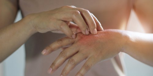Eczema des mains, doigts : causes, quels traitements pour le soigner ?