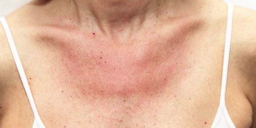 Lucite estivale, polymorphe (allergie au soleil) : symptomes et traitements 