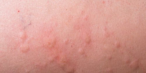 Allergie cutanee : symptomes, reactions, traitements aux eruptions cutanees