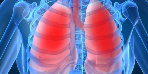 Embolie pulmonaire : des risques plus eleves en cas de cancer