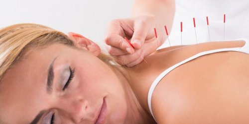 Sciatique : l-acupuncture pour eviter la recidive ?