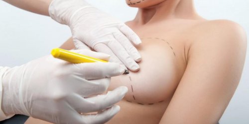 Chirurgie esthetique de la poitrine : l-augmentation mammaire