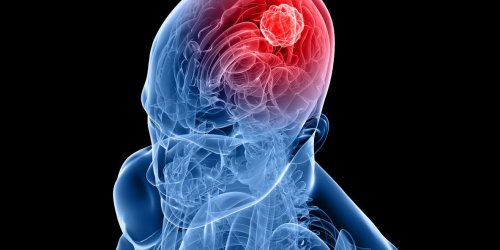 Tumeur cerebrale ou cancer du cerveau : qu-est-ce que c-est ?