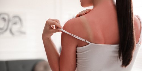 Soleil : les dangers pour votre peau