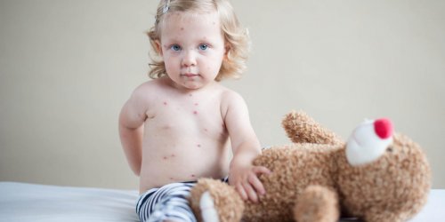 Contagion de la varicelle : comment se transmet-elle ?