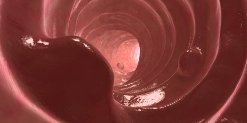 Polypes du colon et rectum (intestinaux) : symptomes, traitements, biopsie