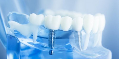 Protheses dentaires : 7 complications que vous risquez si vous en portez une