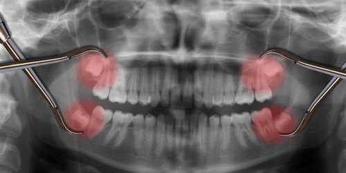Pain in wisdom teeth: up to what age?