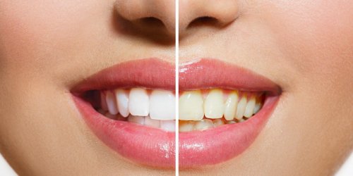 Blanchiment dentaire : 7 choses a savoir avant !